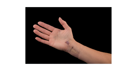 Dupuytren's Contracture Cream